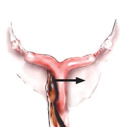 uterus2b